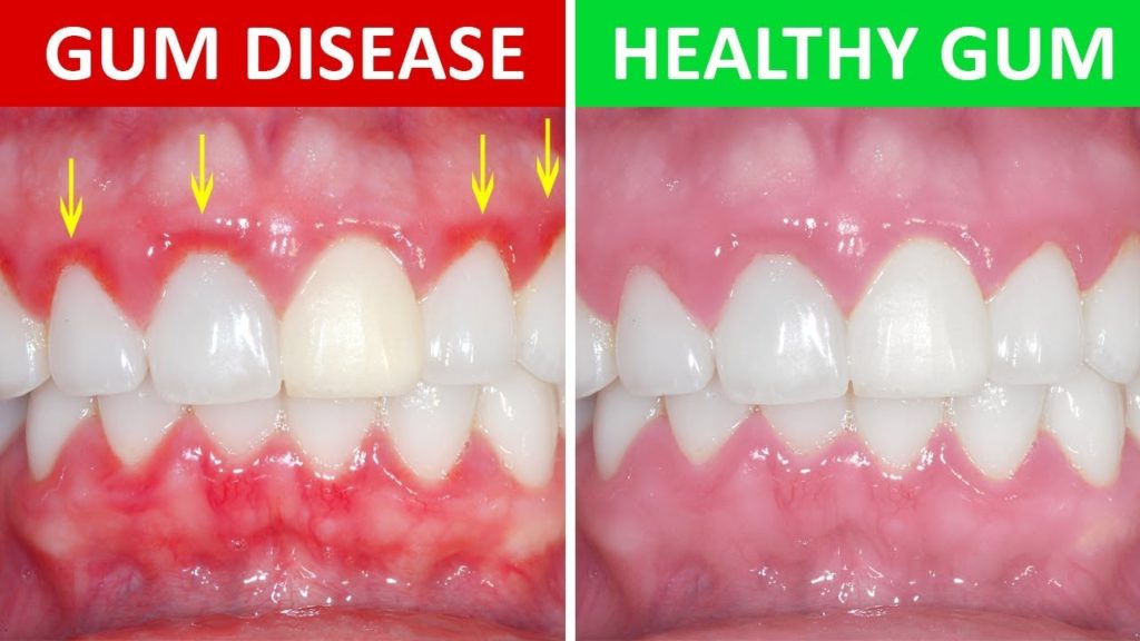 gum-infection-treatment-and-pain-relief-at-root-and-tooth