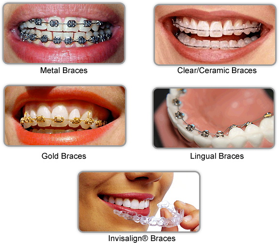 braces for teeth types