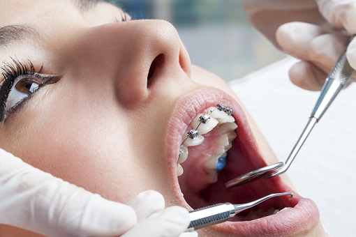Braces treatment at root And Tooth Dental Care